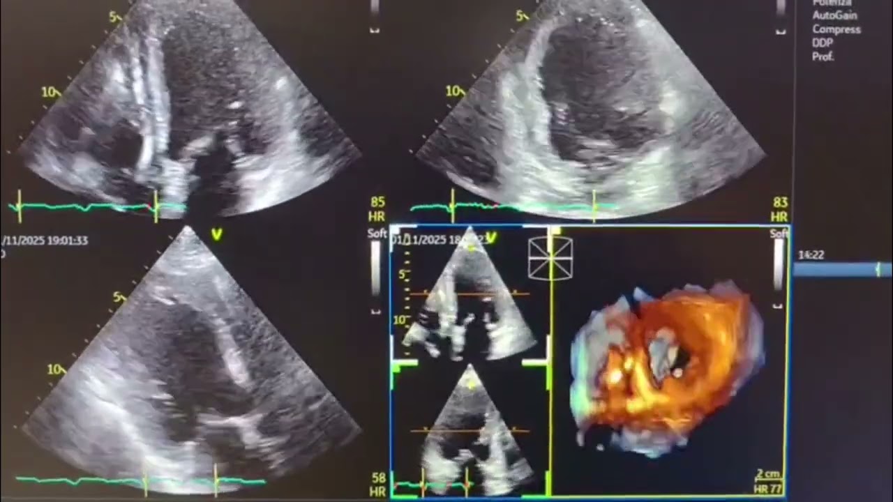 Tornano operativi gli ambulatori di Cardiologia del San Timoteo di Termoli – 11/11/2025